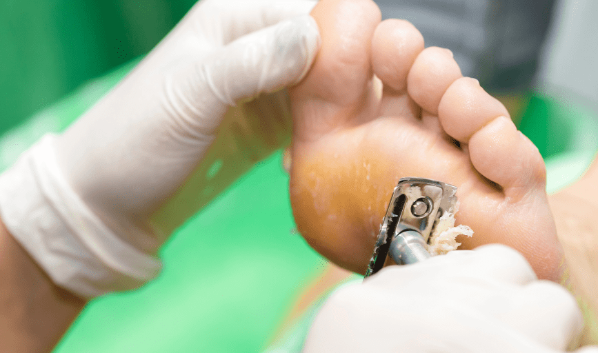 CALLUS REMOVAL